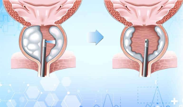 HOLEP-for-Prostate-Enlargement
