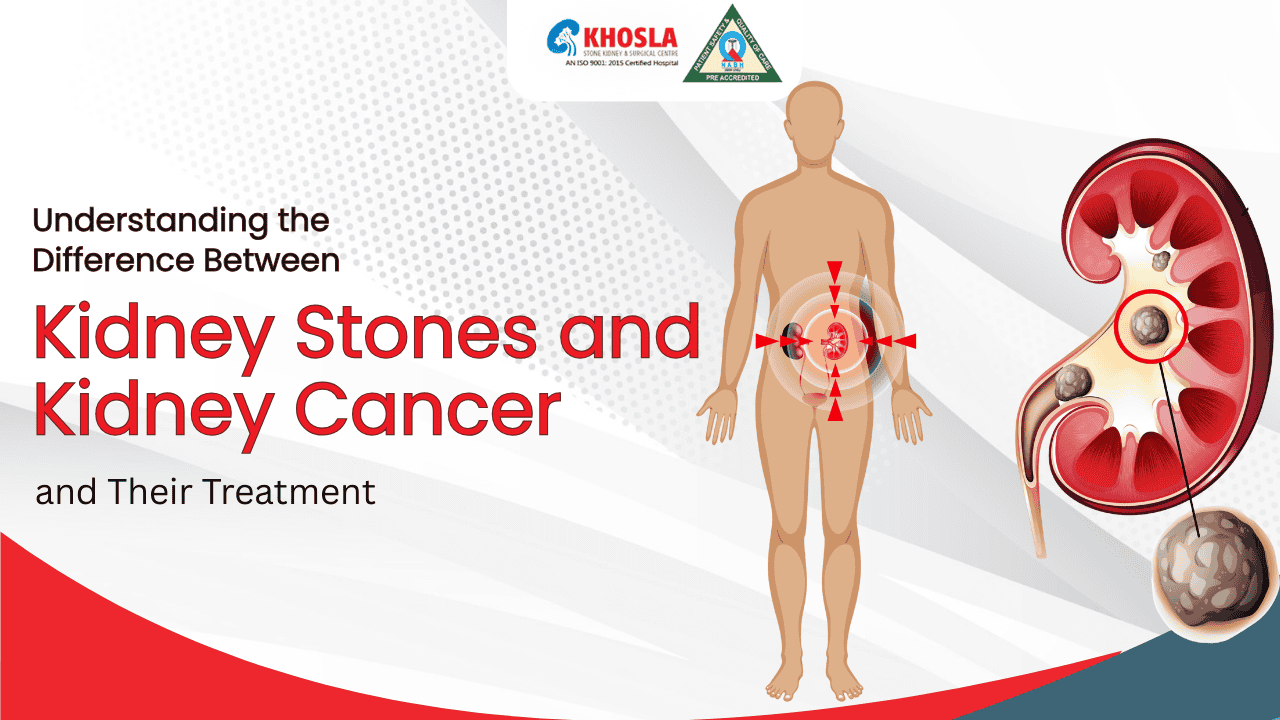 Understanding the Difference Between Kidney Stones and Kidney Cancer and Their Treatment