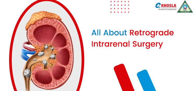 Analysis On RIRS (Retrograde Intrarenal Surgery) For Renal Or Kidney Stones