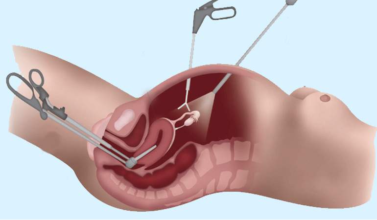 Laparoscopic Hysterectomy: Uterus Removal Surgery in Ludhiana, Punjab