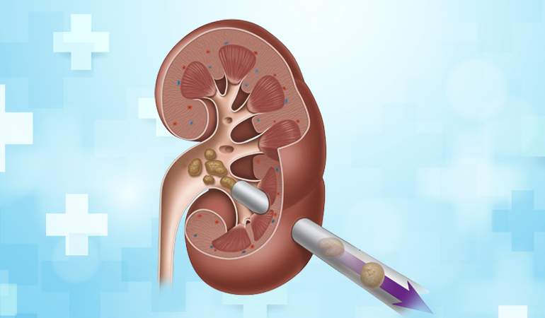 PCNL Procedure For Kidney Stone Treatment in Ludhiana, Punjab