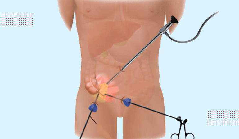 Laparoscopic Appendicectomy: Appendix Removal Surgery in Ludhiana, Punjab