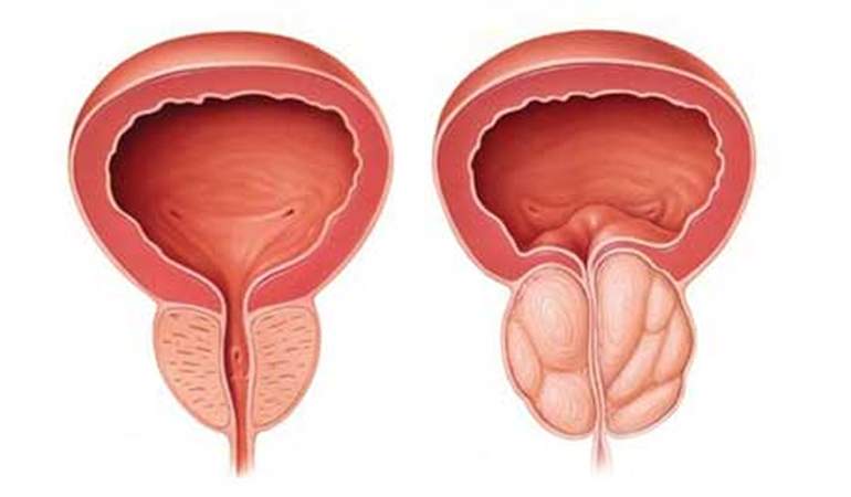 Transurethral Resection of the Prostate (TURP) Surgery in Ludhiana, Punjab