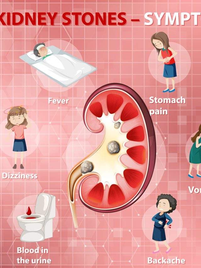 8 Signs and Symptoms of Kidney Stones