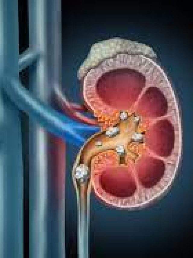 Top 5 Side Effects of Kidney Stones