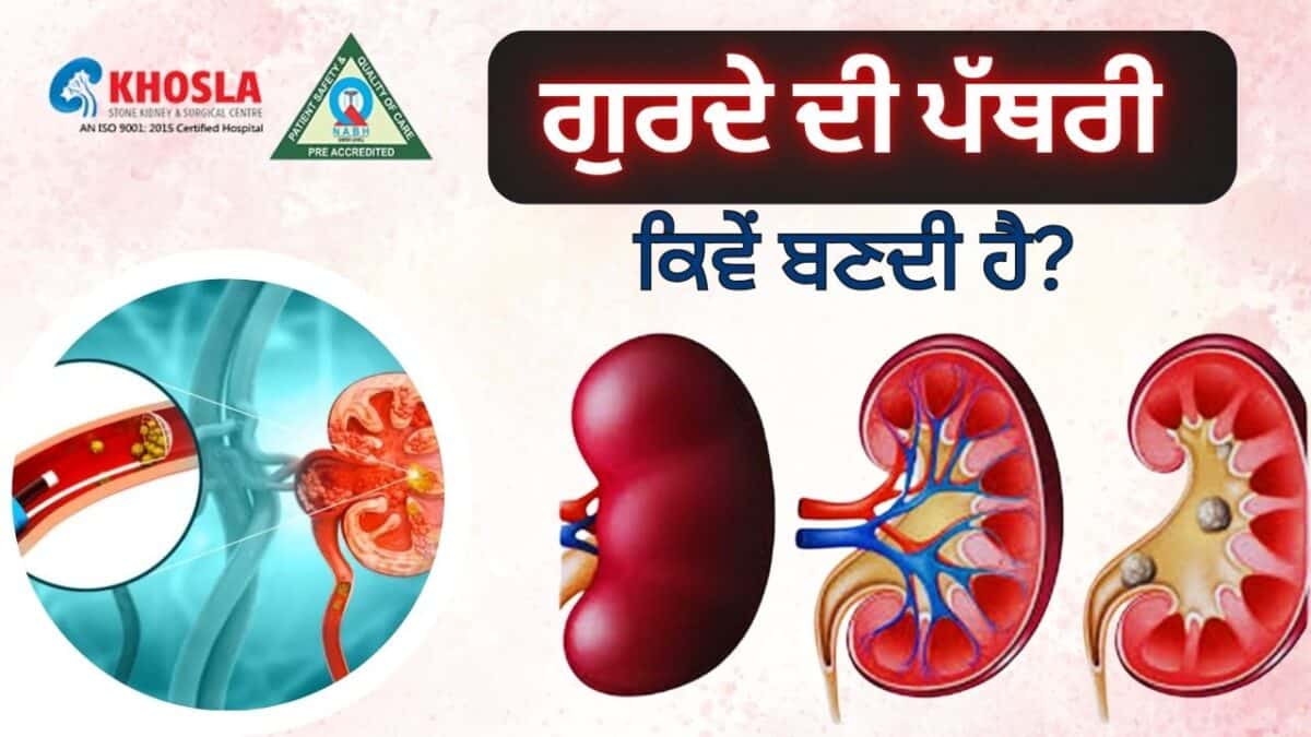 Kidney stone removal procedure diagram at Khosla Stone Kidney & Surgical Centre.
