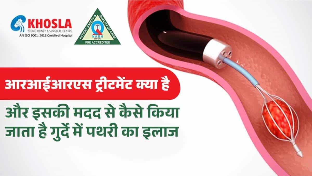 आरआईआरएस ट्रीटमेंट क्या है और इसकी मदद से कैसे किया जाता है गुर्दे में पथरी का इलाज