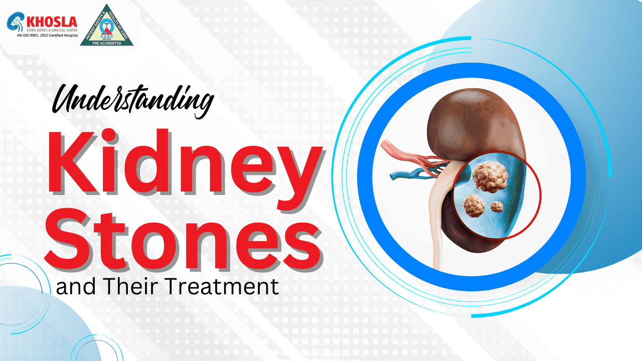  Understanding Kidney Stones and Their Treatment