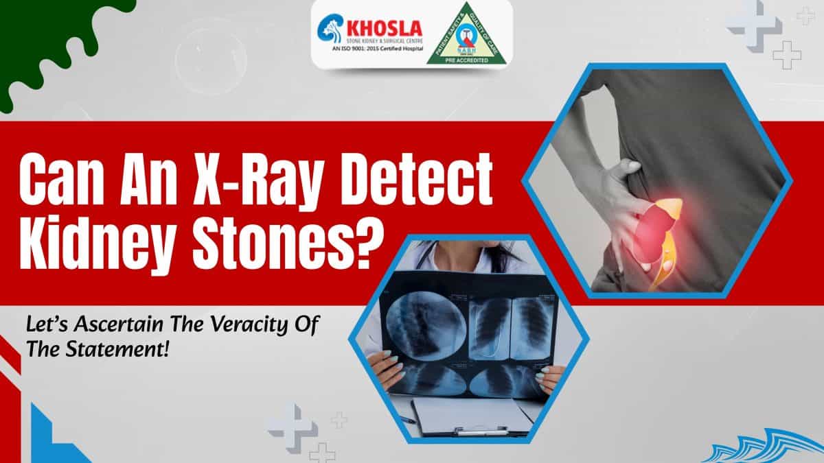 Can An X-Ray Detect Kidney Stones? Let’s Ascertain The Veracity Of The Statement!